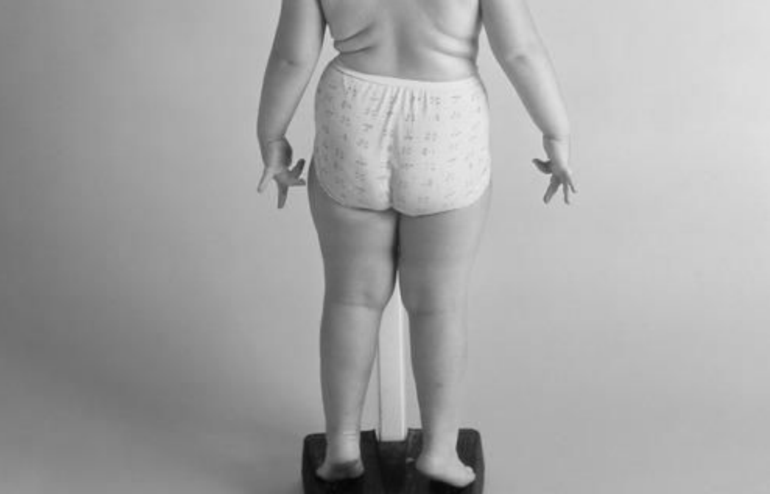 Poverty-stricken Children’s Obesity
